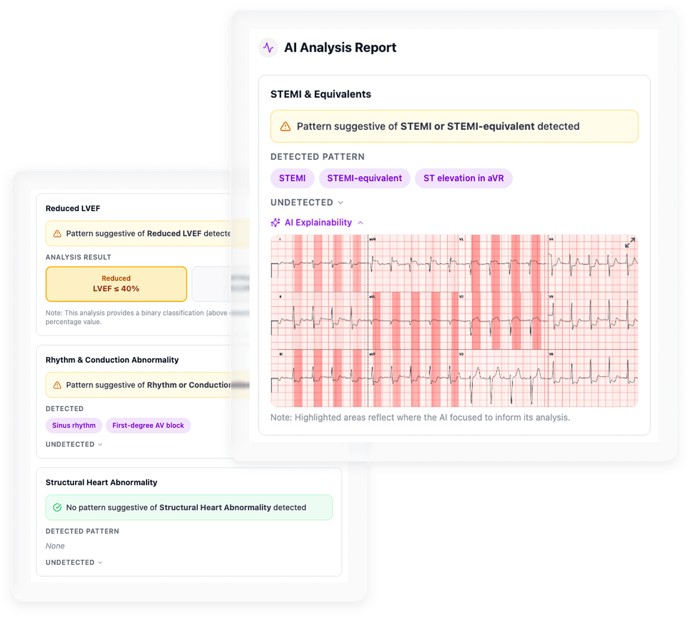 Evom ECG AI electrocardiogram analysis screen