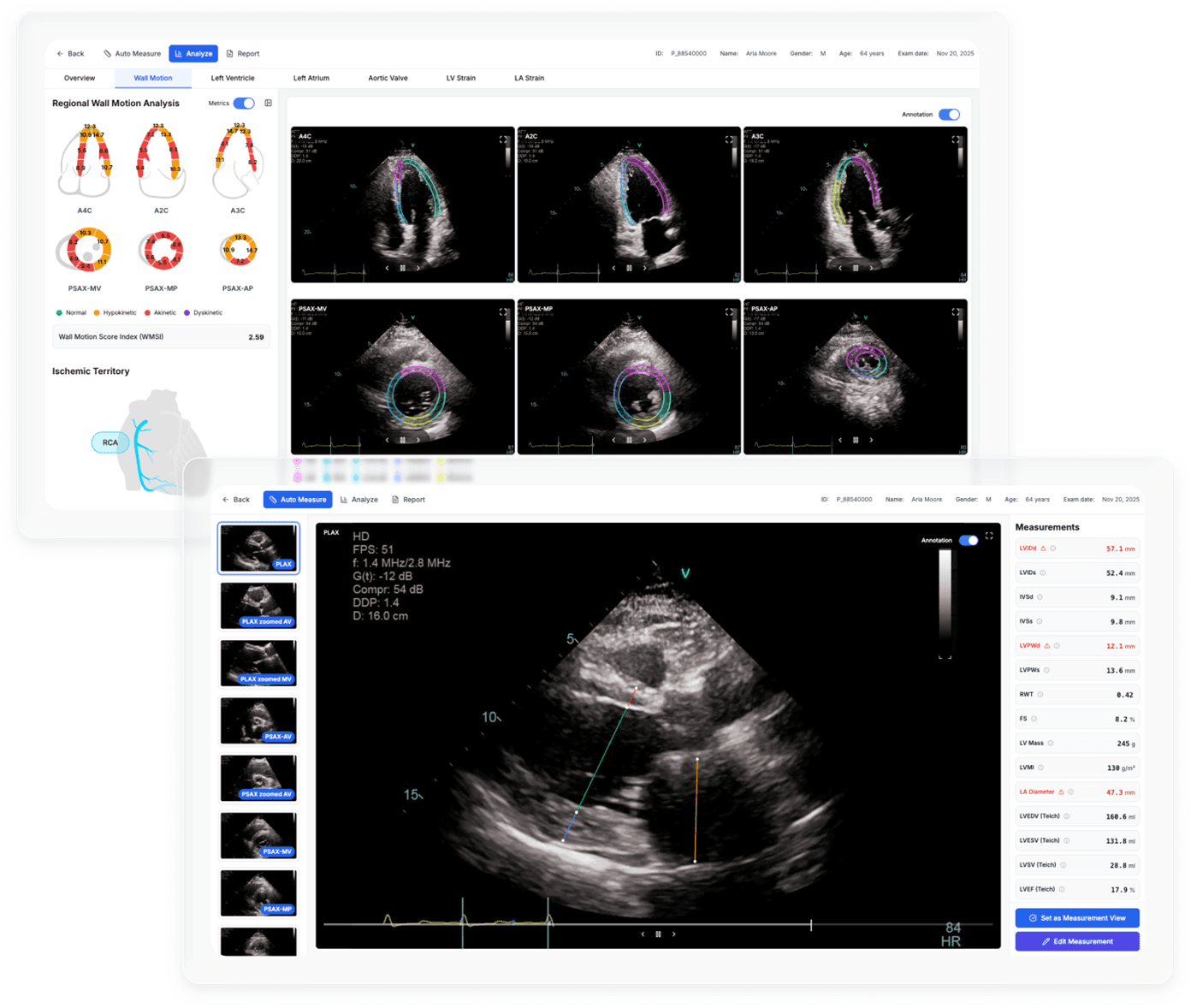 Evom Echo AI echocardiography analysis screen